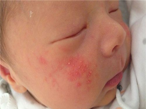 ＂安徽安科生物工程＂宝宝母乳性黄疸多久能退、宝宝母乳性黄疸多久能退完